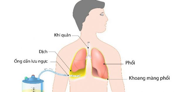 Dẫn lưu màng phổi do tràn dịch