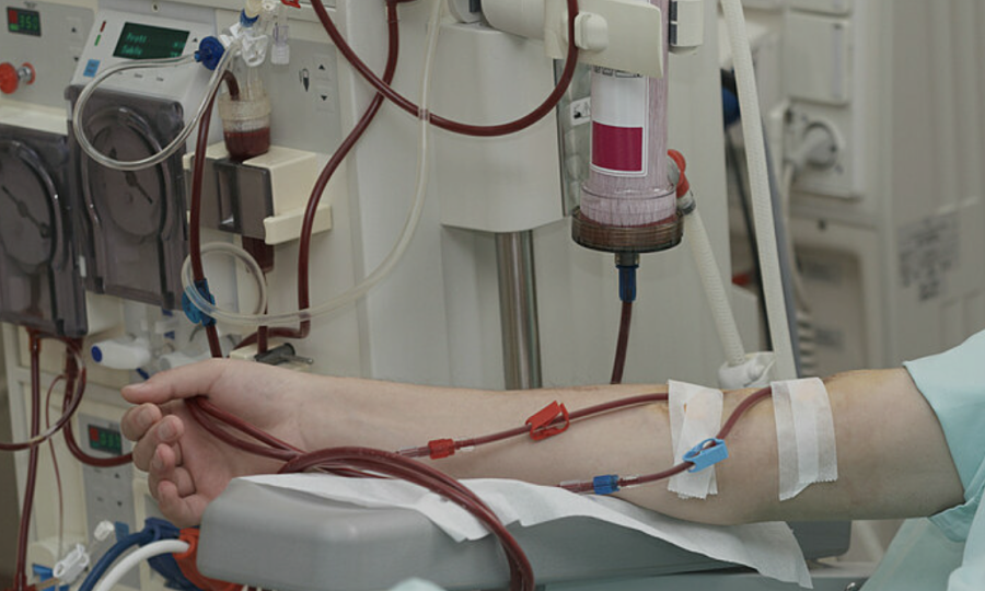 Thực hư việc lọc máu giúp ngăn ngừa đột quỵ