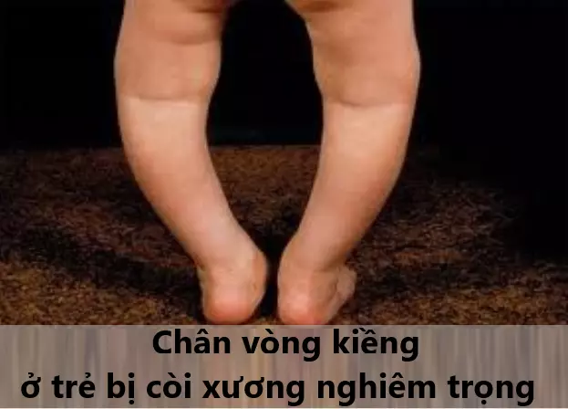 Hình ảnh chân của trẻ bị còi xương nghiêm trọng