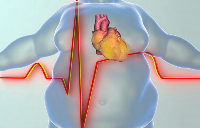 Béo phì làm tăng nguy cơ mắc các bệnh lý tim mạch