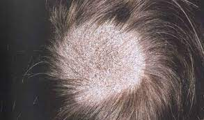 Rụng tóc thành mảng do nấm da đầu.