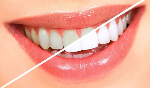 Cách làm trắng răng tại nhà và giữ răng không bị ố vàng tốt nhất