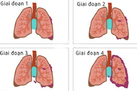 4 giai đoạn của ung thư phổi không tế bào nhỏ