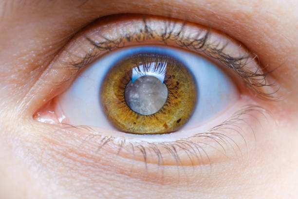Đục thủy tinh thể là nguyên nhân gây mù lòa phổ biến nhất