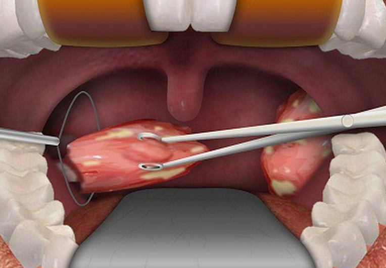 Hình ảnh phẫu thuật cắt amidan