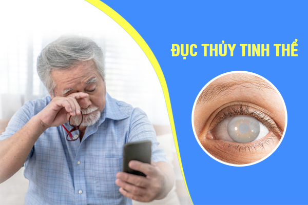 Đục thủy tinh thể là nguyên nhân gây suy giảm thị lực và mù lòa hàng đầu