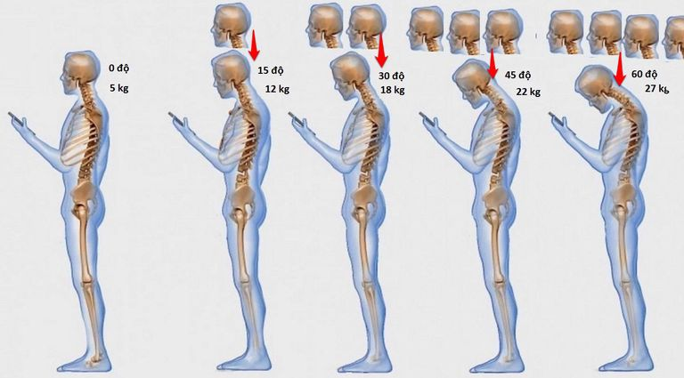 Cúi đầu để sử dụng điện thoại khiến các cơ ở cổ phải chịu trọng lượng nhiều hơn.