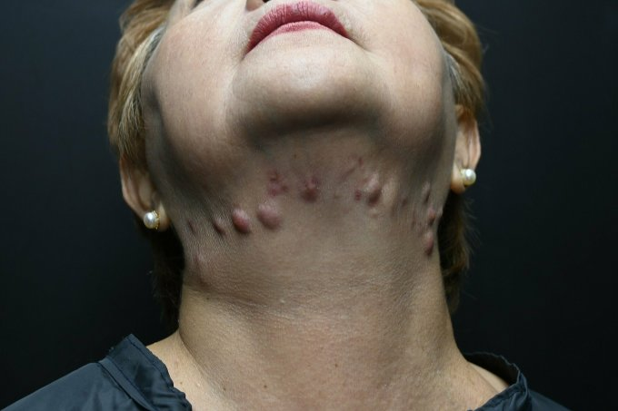 Tiêm xóa mỡ nọng cằm: Nhiều người bị biến dạng da vùng mặt