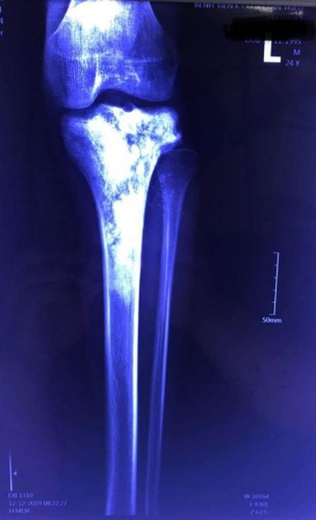 Lần đầu tại Việt Nam: Cắt bỏ khối ung thư xương chày, bảo tồn được chân của bệnh nhân